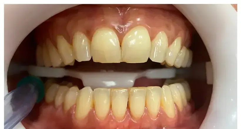 Sorriso antes do clareamento dental