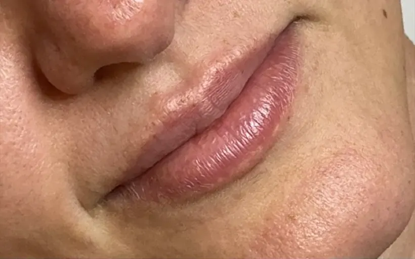 Lábios antes do preenchimento labial
