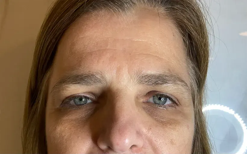 Região frontal antes da aplicação de toxina botulínica