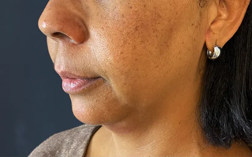 Terço inferior do rosto antes da harmonização orofacial